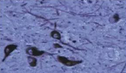 正凡人：黑质神经元保存