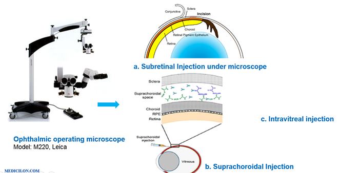 特殊的眼部球内给药手艺