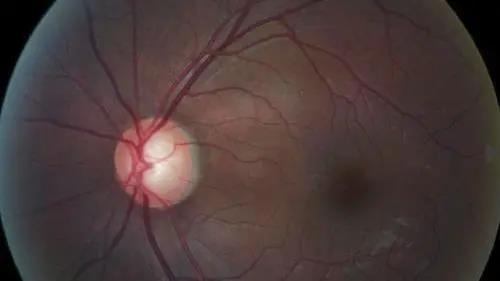 青光眼的克星来袭，，，，，，助力患者远离视力的“窃贼”