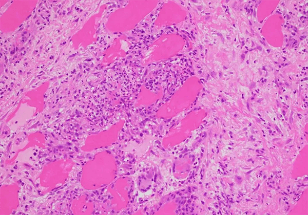 【米乐YY易游助力】治疗结节病的KBMAB-16获FDA批准临床